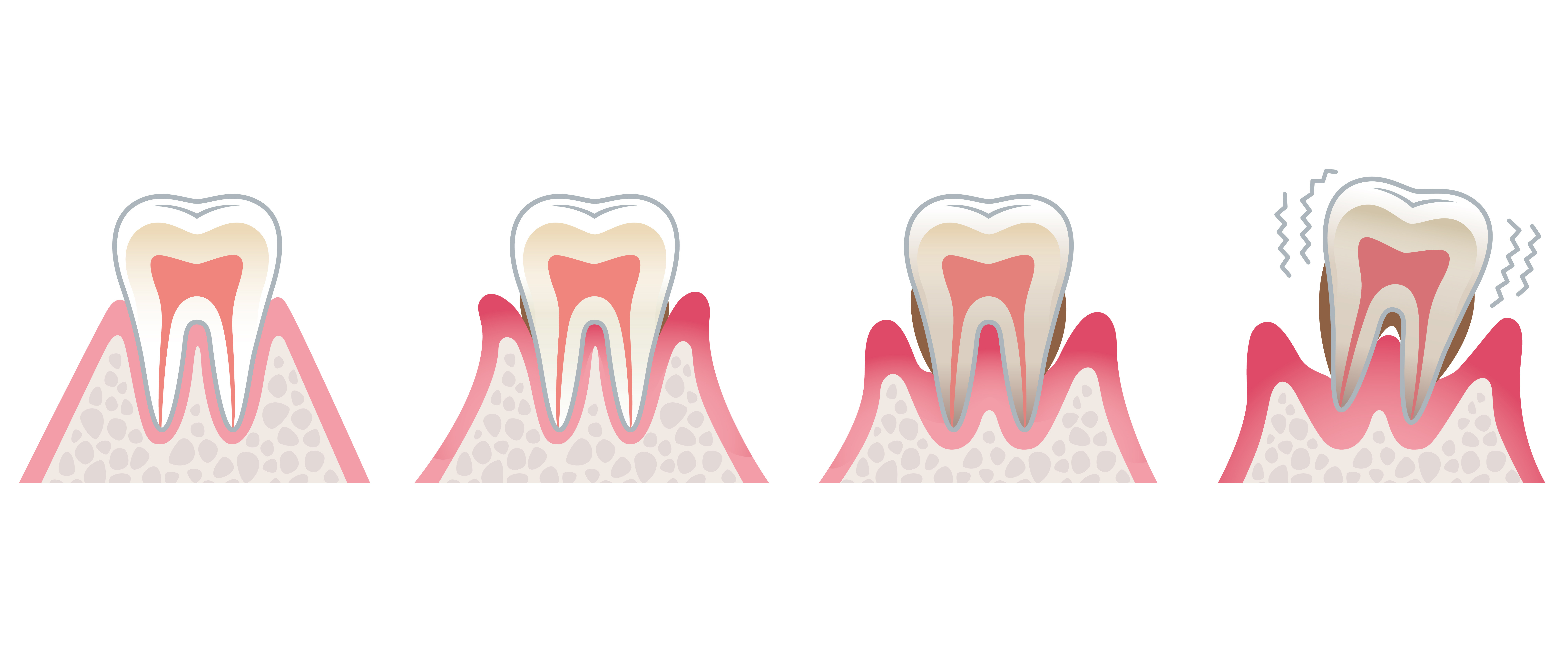大阪市 上本町 歯周病検査 再生治療