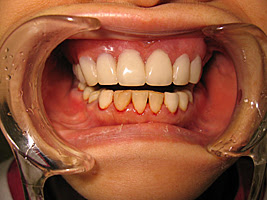 マグネット総入れ歯 フィンデンチャー 上領歯科医院