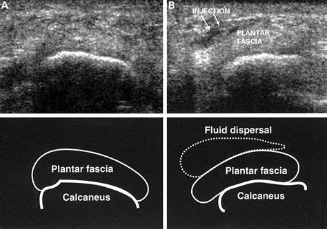 Webmd shows you what you can do to feel better. Ultrasound guided injection of plantar fasciitis | Annals