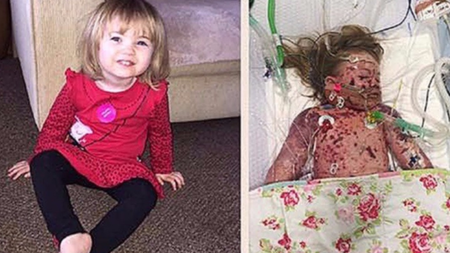 Meningitis B vaccination roll-out 'not cost effective' - ITV News