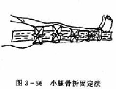 骨折固定 A 医学百科
