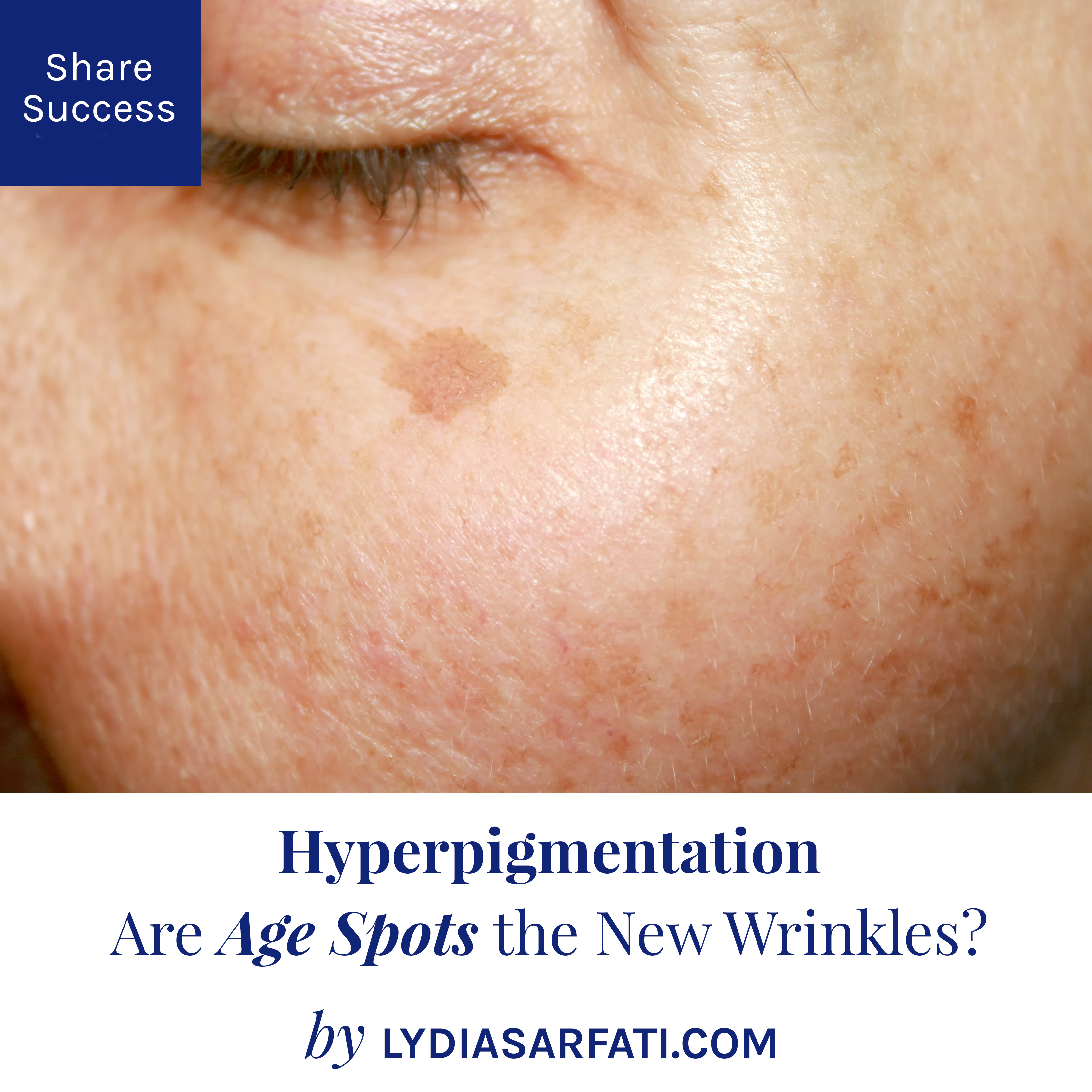 Hyperpigmentation Are Age Spots The New Wrinkles Lydia Sarfati Skin Care Blog