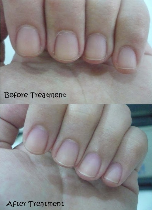 How to Get Rid of Yellow Nails | Active Home Remedies