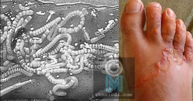 Doktor Dedah Makanan Yang Ada Beribu Cacing Didalamya Yang Sering Anda Makan Sehari-Hari
