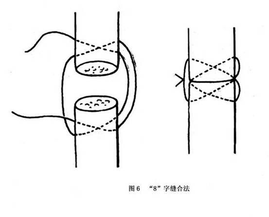 手部屈指肌腱损伤治疗方法 如何治疗手部屈指肌腱损伤 查疾病 疾病大全 医网