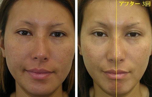 プレミアムシンメトリー 顔の歪み専門矯正 関西プロポーション小顔センター 大阪梅田院