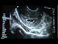 √70以上 baby 5 weeks 6 days 726044-Baby heartrate 140 at 5 weeks 6 days pregnant