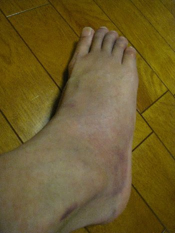 下駄骨折 から 1週間 かなり腫れがなくなりました N Shimomuraのひとり言