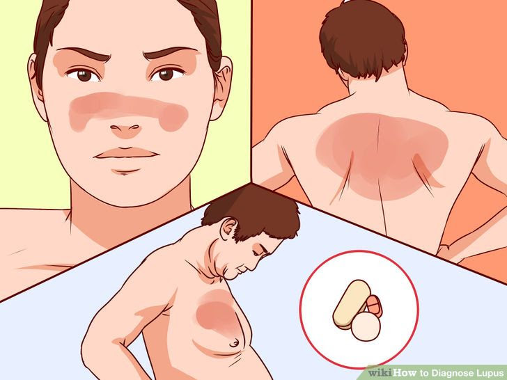 Diagnose Lupus Step 17.jpg