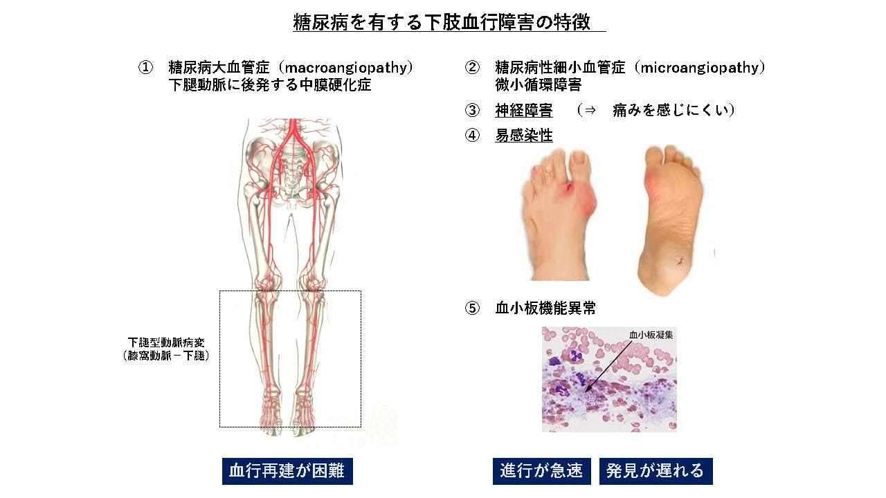 足の潰瘍 かいよう 足の壊疽 えそ 下肢間歇性跛行 足の潰瘍 壊疽 下肢血行障害でお困りの患者さまへ 山形済生病院 社会福祉法人 恩賜財団 済生会