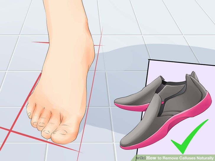 Remove Calluses Naturally Step 16 Version 2.jpg