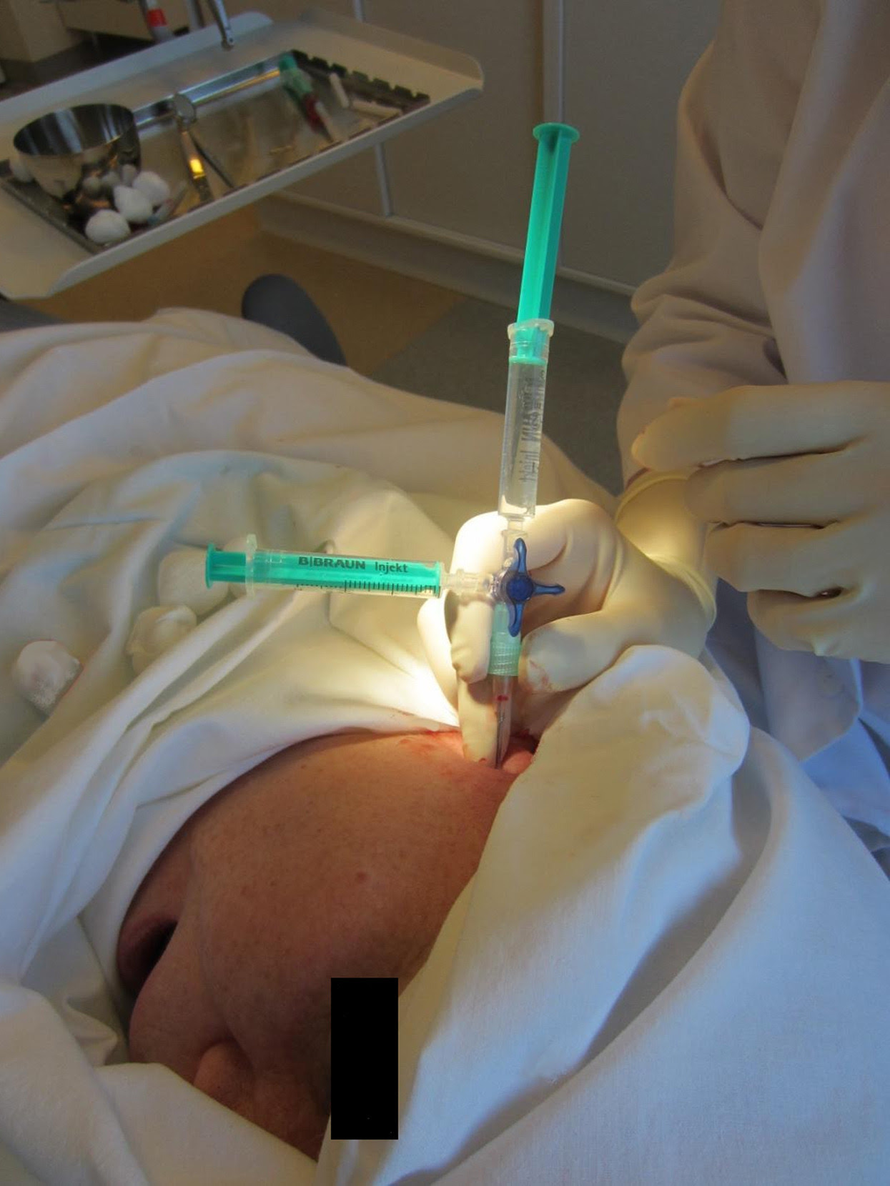 Intramuscular botulinum toxin injection additional to ...