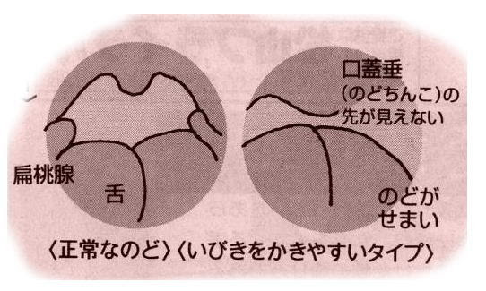 いびきと睡眠時無呼吸