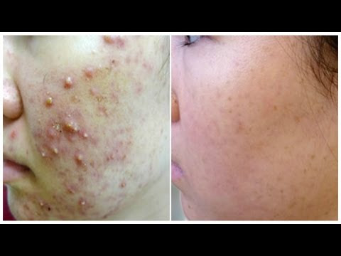 Overnight Removal Of Acne & Acne Scars 