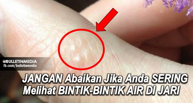 JANGAN Abaikan Jika Anda SERING Melihat BINTIK-BINTIK AIR DI JARI, WAJIB BACA !