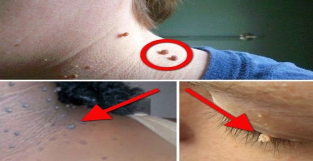 Jika Anda Ada Tumor Fibroid/Kulit Berlebihan Di Tubuh,Ini Cara Mudah Hilangkan Guna…