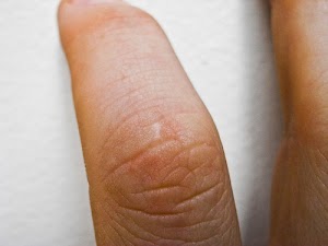 Acne Scar Treatments • Skin Care Ϝor Scars