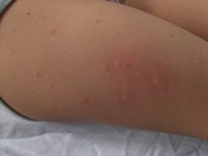 体がかゆい ぶつぶつや湿疹の原因は 実は薬が効きにくいので対処をしっかりしよう 100テク 2ページ目