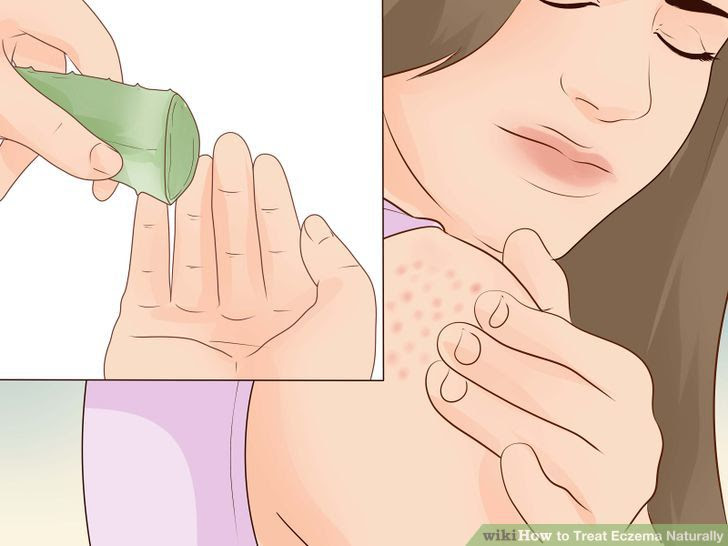 Treat Eczema Naturally Step 8 Version 3.jpg