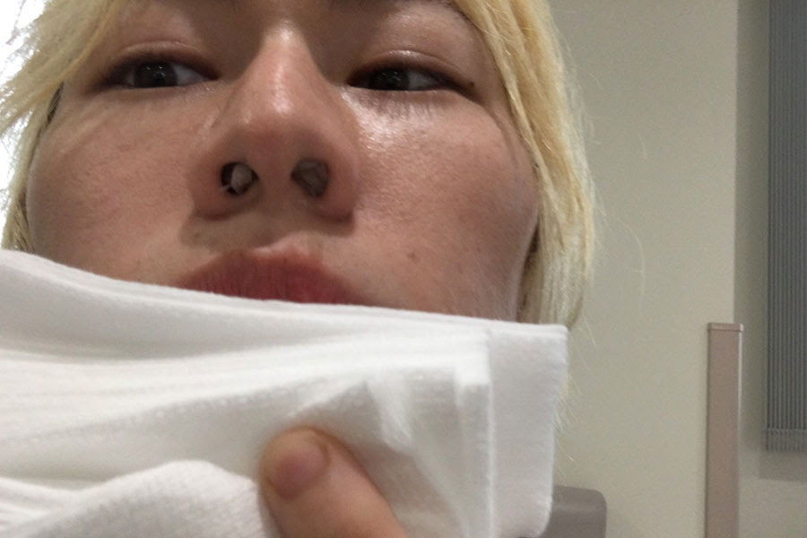 花粉症 鼻炎のレーザー治療を受けてきた 手術編 ロシア人彼女と日本人彼氏の遠距離恋愛ブログ