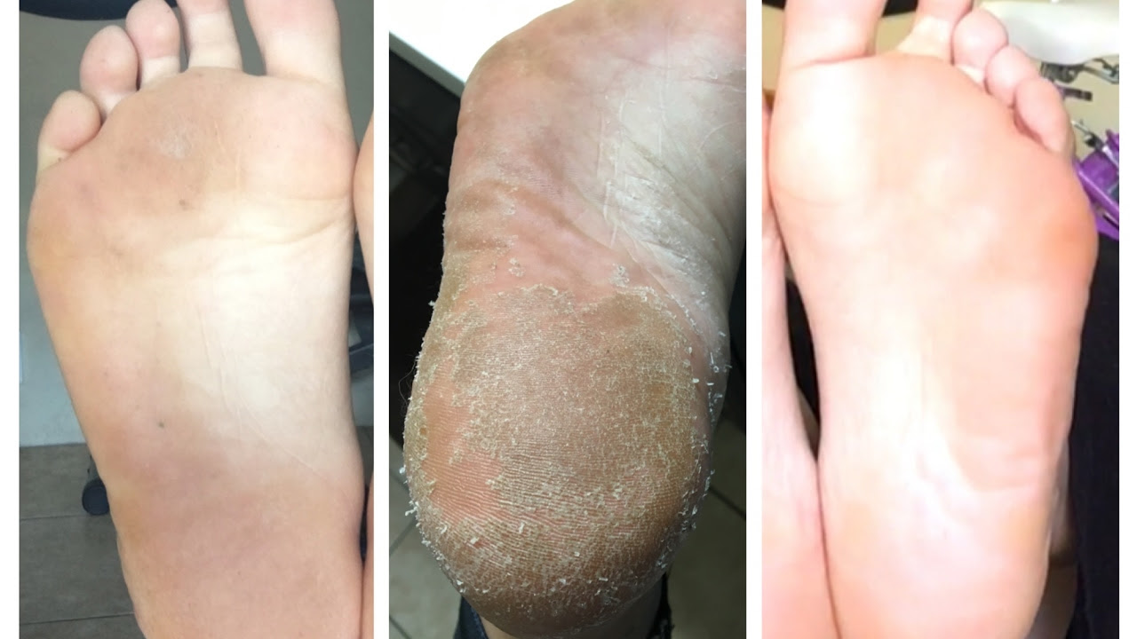 Baby Foot Peel: I Tried It And Hereaposs What Happened