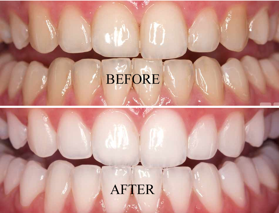 Do You Have Yellow Teeth?