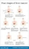 Skin Cancer Yellow / Skin disease - Localized skin diseases | Britannica.com - Although the percentage of cases in men is much lower than in women, male breast cancer accounts for a por.