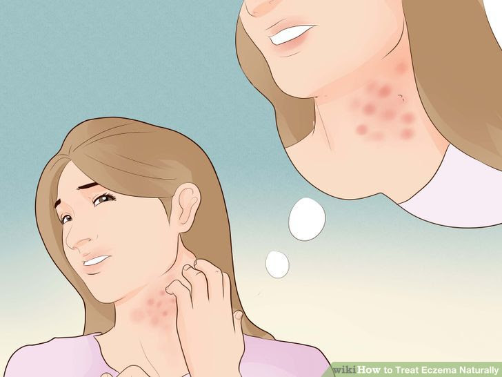 Treat Eczema Naturally Step 20.jpg