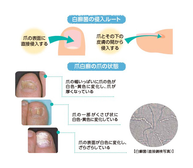 水虫 爪水虫 爪白癬 治療について 京都 堀川御池 友愛診療所 内科 消化器内科 胃腸内科 小児科 皮膚科