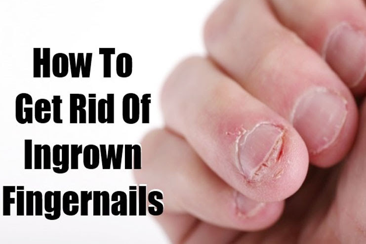 How To Treat Ingrown Fingernails