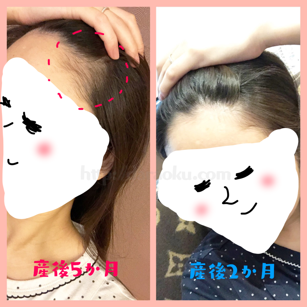 追記 産後の抜け毛と乾燥と シャンプー比較と実際に使ったレビューまとめ だら奥様のマネ活術