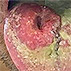 Disseminated Coccidioidomycosis