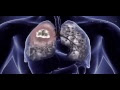 Get Mesothelioma With Lung Metastasis Gif