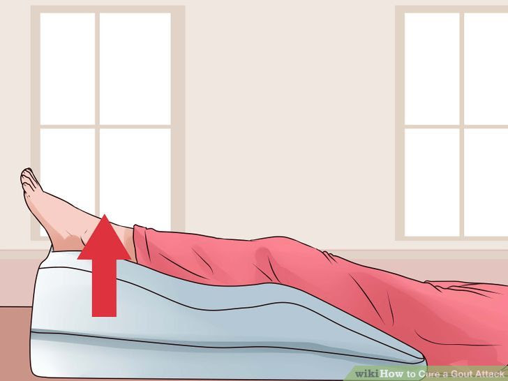 Cure a Gout Attack Step 4 Version 2.jpg