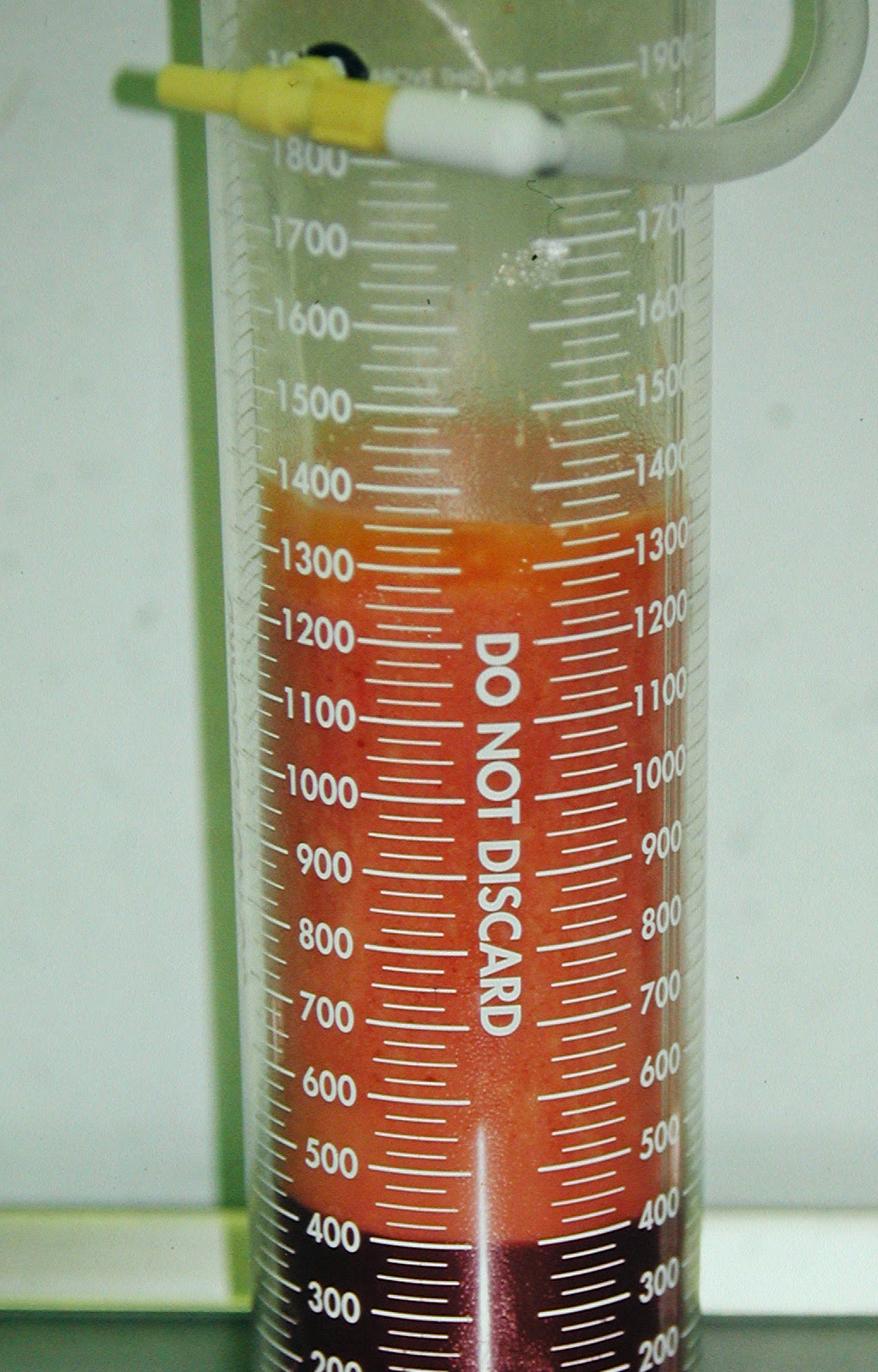 liposuction 1 liter of fat removed