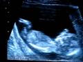 [dernier] echographie bebe garcon 3 mois 992769