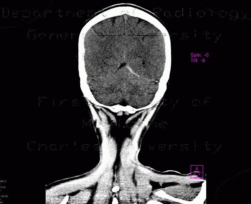 Cranial fossa, the tomography demonstrated We can be seen in the saldino, Review ronald m di chiro, , physiological intracranial calcification Formation,