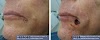 Skin Cancer Mohs Surgery - 8 Breast Cancer Signs to Look For | The Doctors TV Show