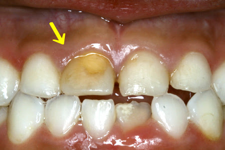 以前 転んで打った乳歯が変色してきました 静岡市葵区の歯医者 みまつ渡辺歯科医院 静岡の総合歯科です