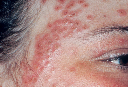 bronchitis walking pneumonia symptoms