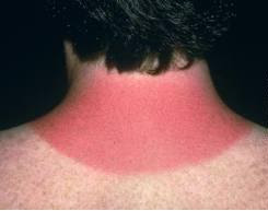  Home Remedies For Treatment Of Sunburn