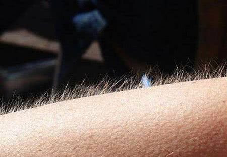 多毛症是年轻女性厌恶的问题 医生 多毛症对治疗反应缓慢 积极配合治疗 刷刷看小说网