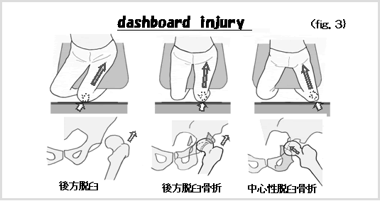 これからも増える人工股関節 Tha の撮影と読影