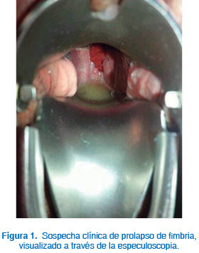 Prolapso de fimbria como complicación de histerectomía ...