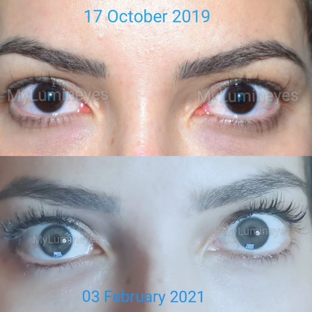 Comment Changer La Couleur Des Yeux Laser Keratopigmentation Implant