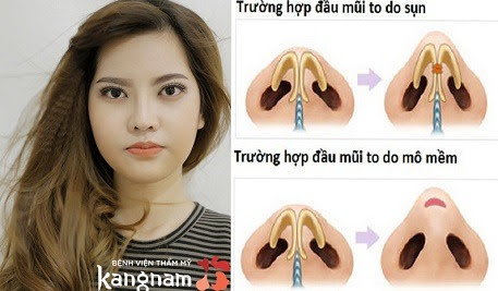 Thu nhỏ đầu mũi như thế nào-1