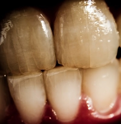 Hairline Cracks in Front Teeth
