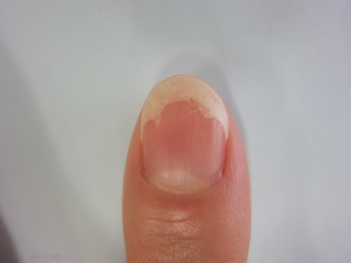 爪甲剥離症 治験例13 あん鍼灸院 あん鍼灸院