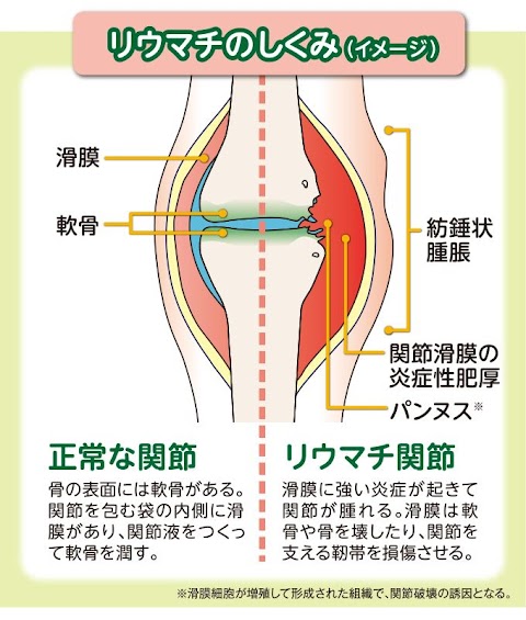 リウマチ 似 て いる 病気