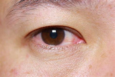 pink eye eye infections symptoms ceenta